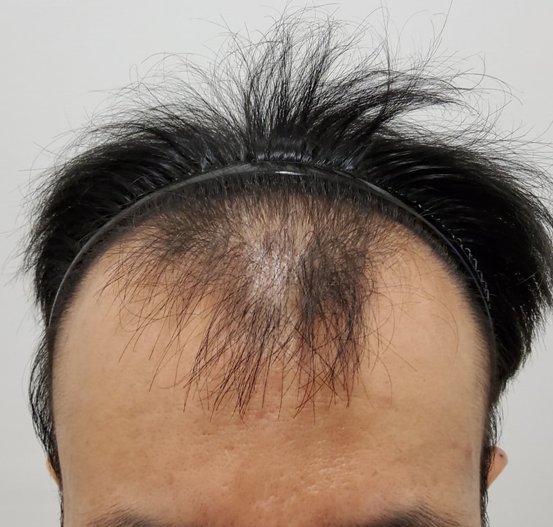 비절개로 모발이식 받고왔습니다.