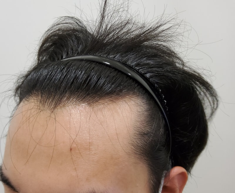 1. 수술전_2.jpg