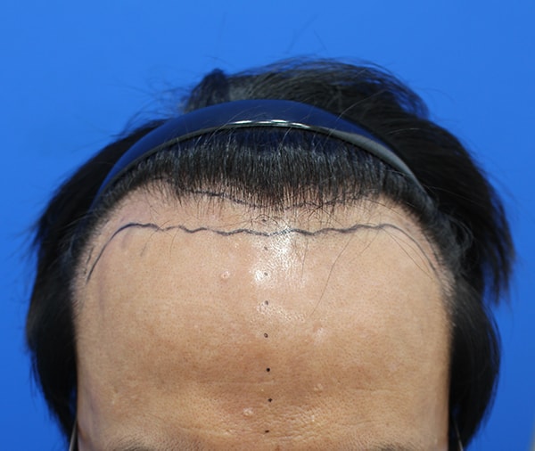 Hannaeve plastic surgery Plastic Surgery Department's 3,100-mo incision transplant, 5 months later