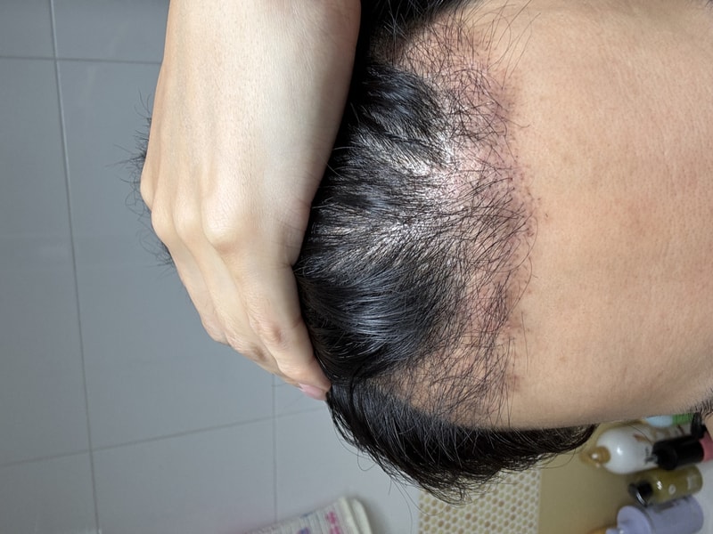 뉴헤어 절개이식 4주차 결과입니디.