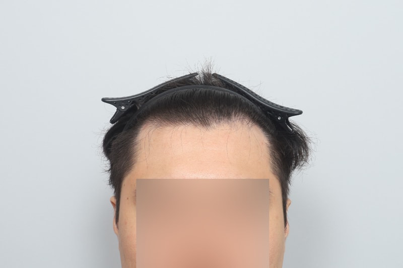 No-cut non-cut Hair Transplant 2nd week of MO.1 plastic surgery
