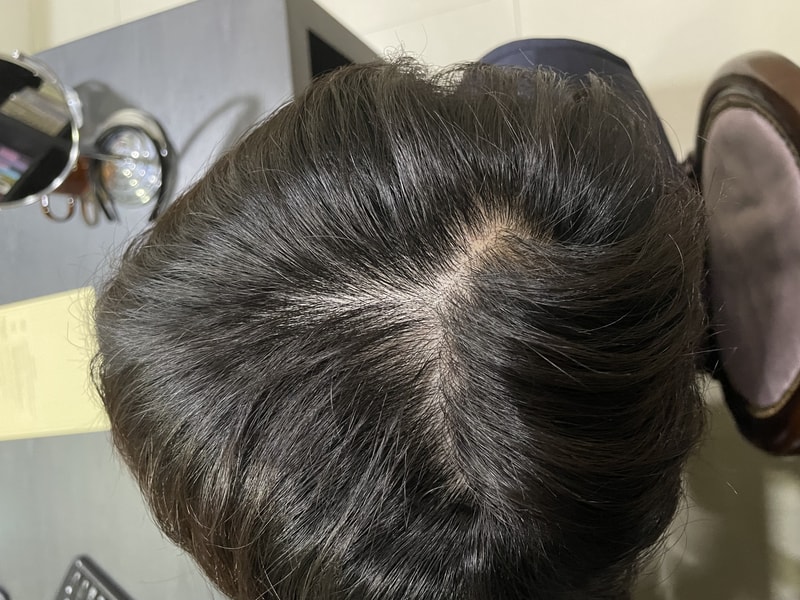格洛威尔头皮纹身后期