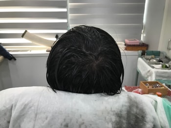 시술후 젖은머리