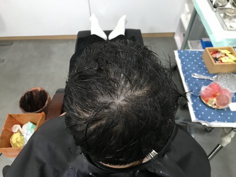 延世ミダインで頭皮刺青を受けました