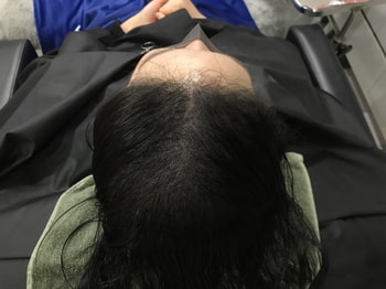 시술후
