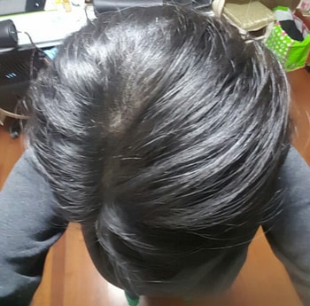 시술 1차후 샴푸후