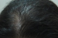 DMP 두피문신후기!