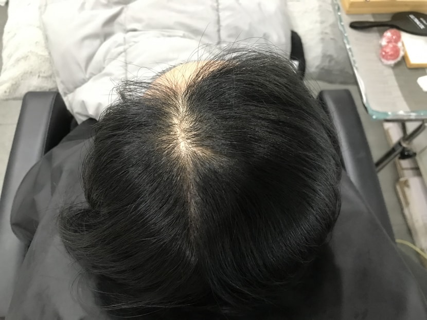 시술 전
