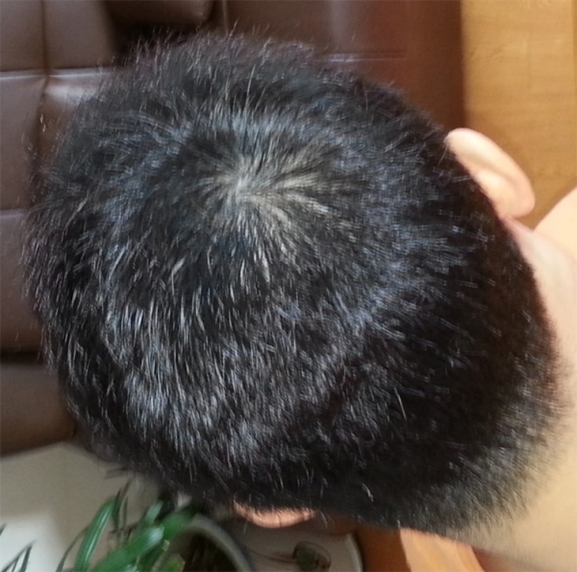 시술후6일 우측(플래쉬 터트리고)