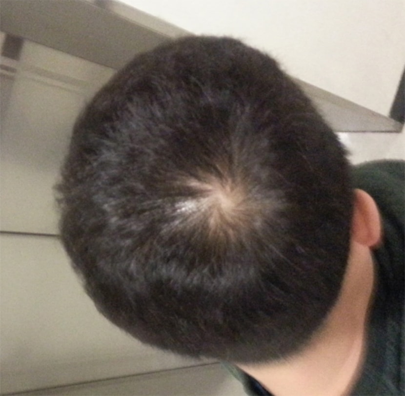 시술전 우측(플래쉬X)