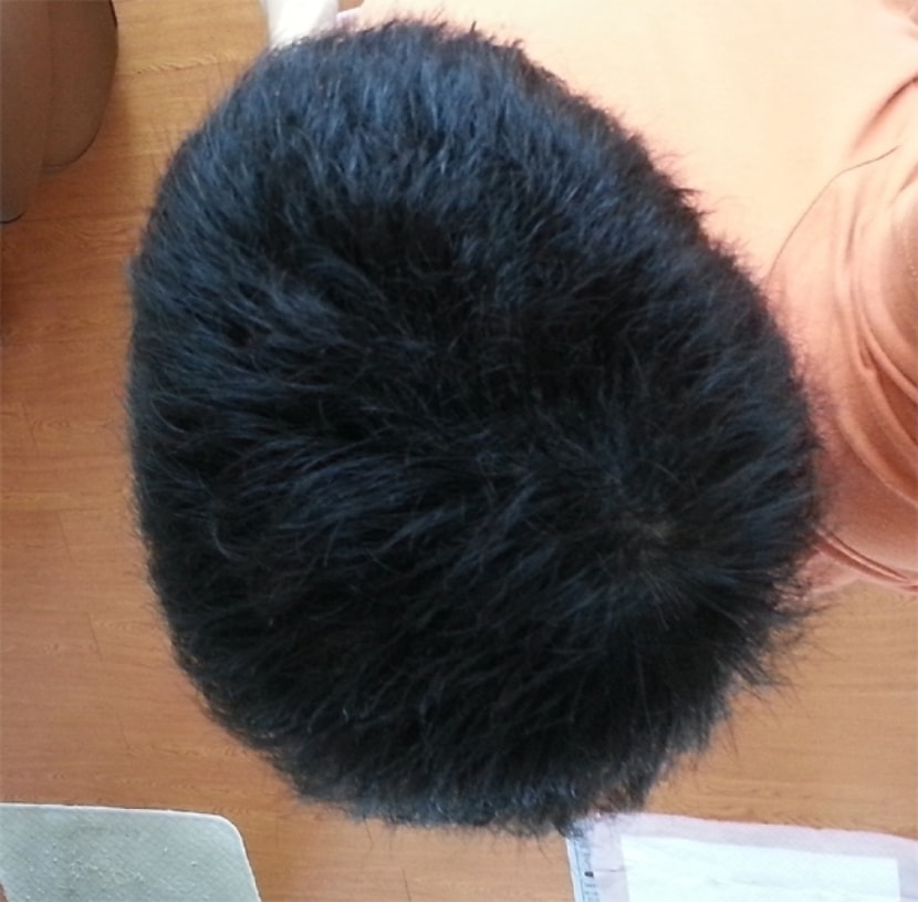 시술후6일 중앙(플래쉬X)