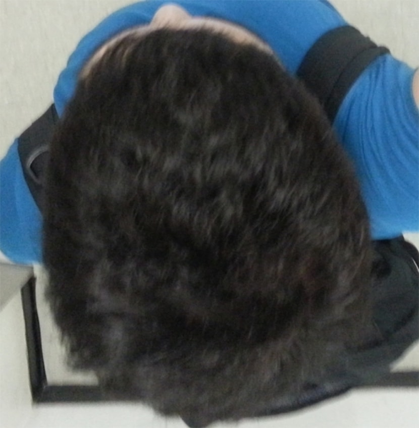 시술직후 중앙(플래쉬X)