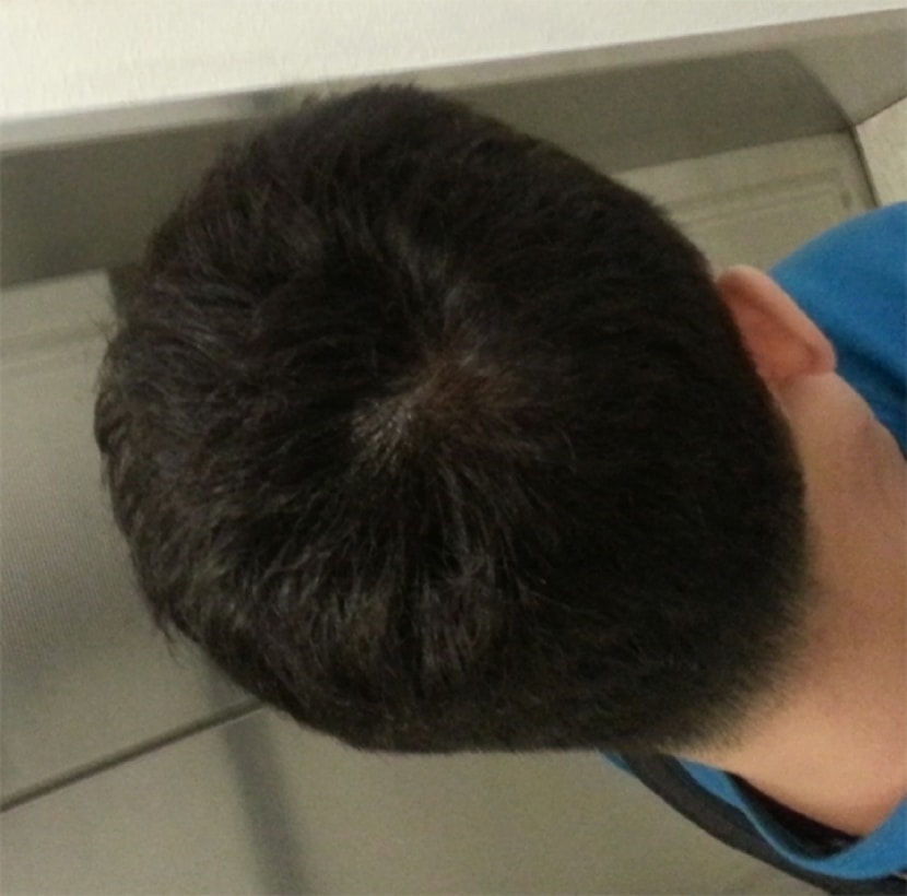 시술직후 우측(플래쉬X)