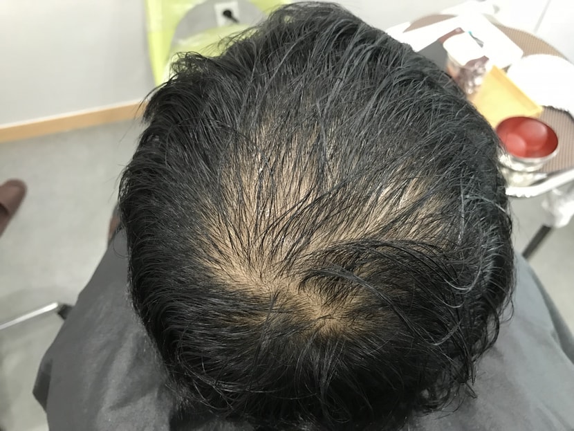 시술전 젖은 상태