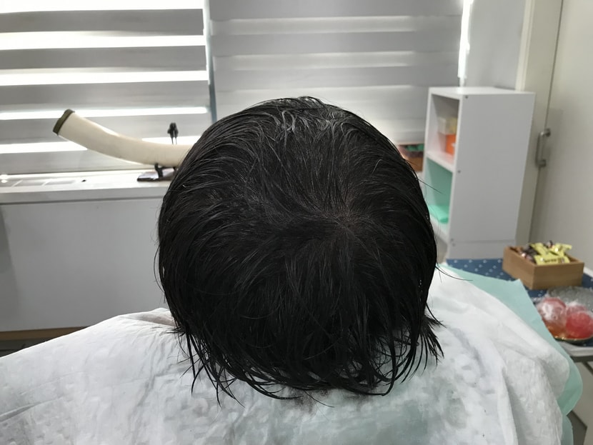 이사진들은 2차 두피 문신을 받은 후 사진입니다