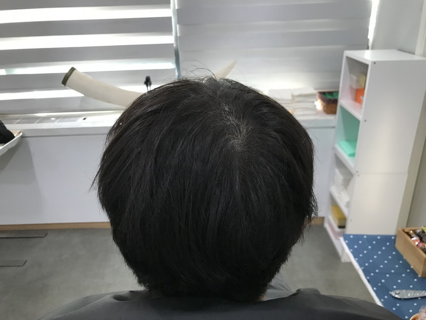 위 사진들이 2차 두피 문신을 받기 전 입니다.
