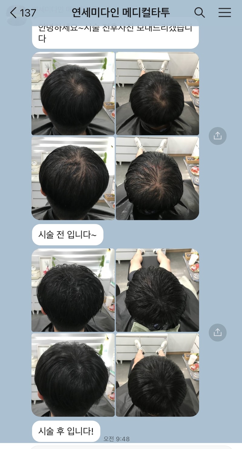 头皮纹身1次手术后记