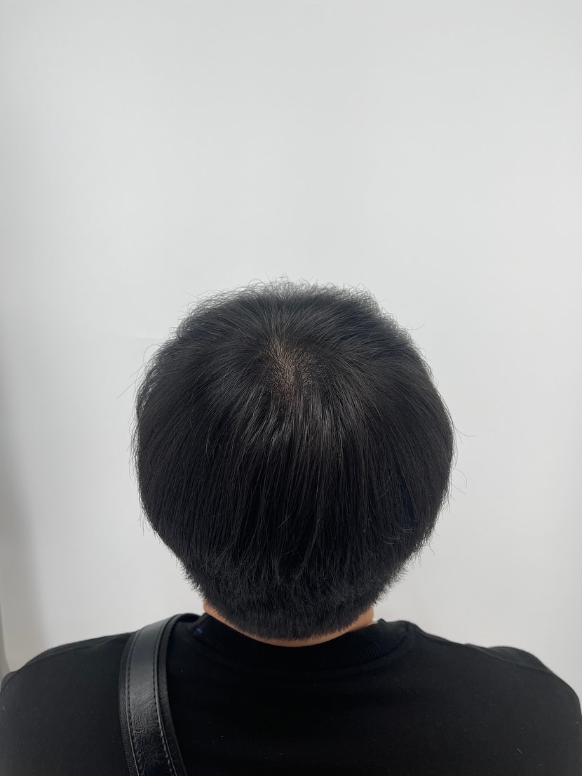 시술후
