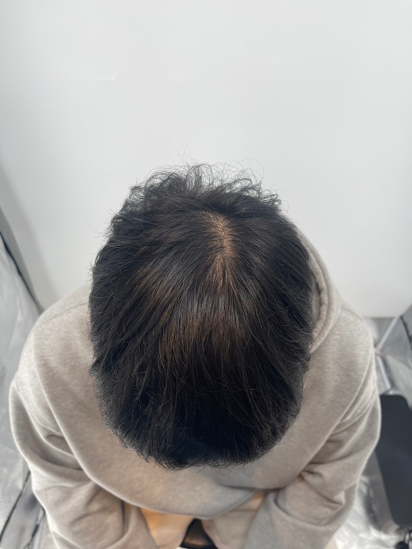 시술전