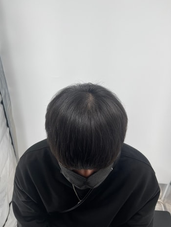 시술후