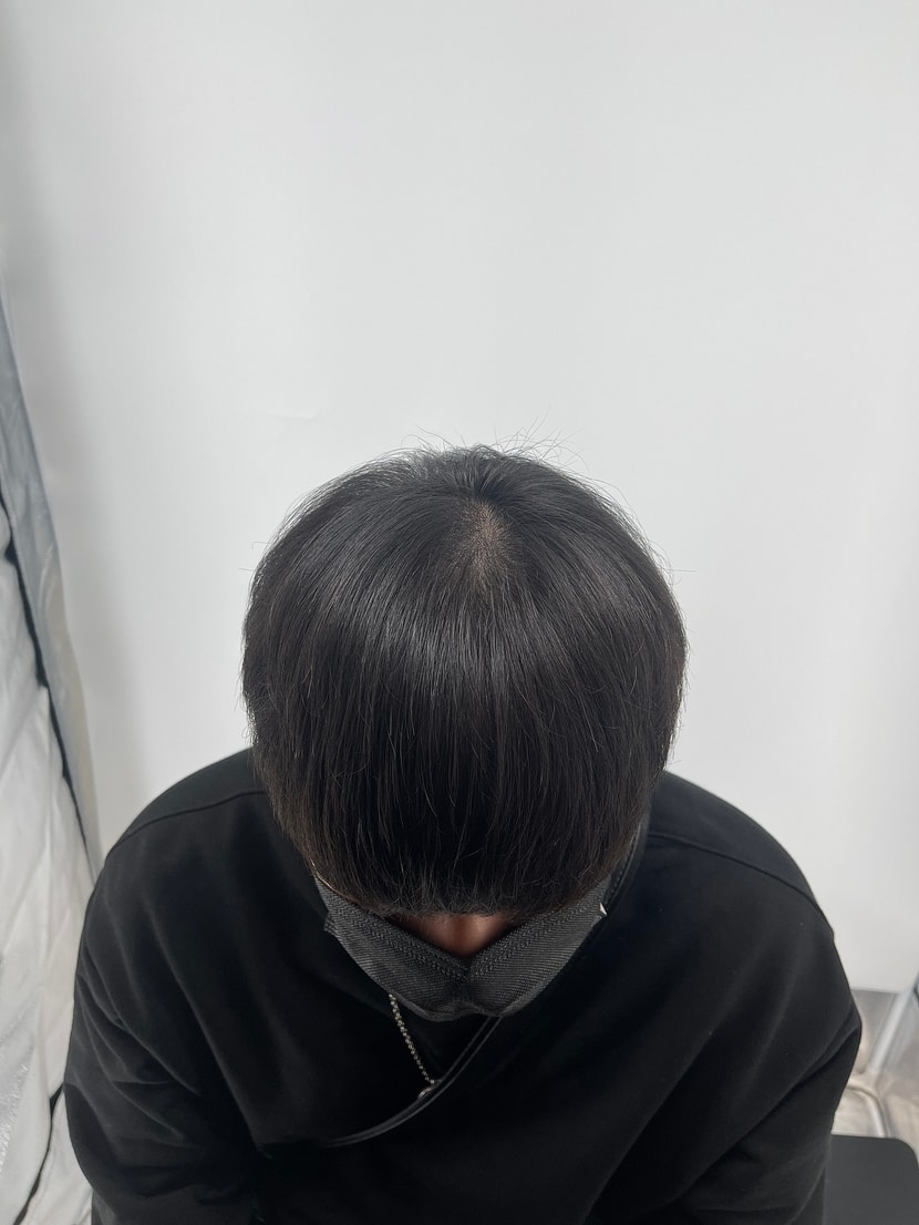 시술후
