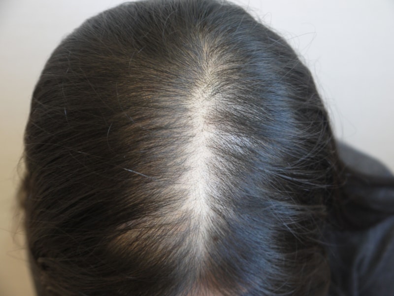 디엠피 두피문신 시술 후기입니다.