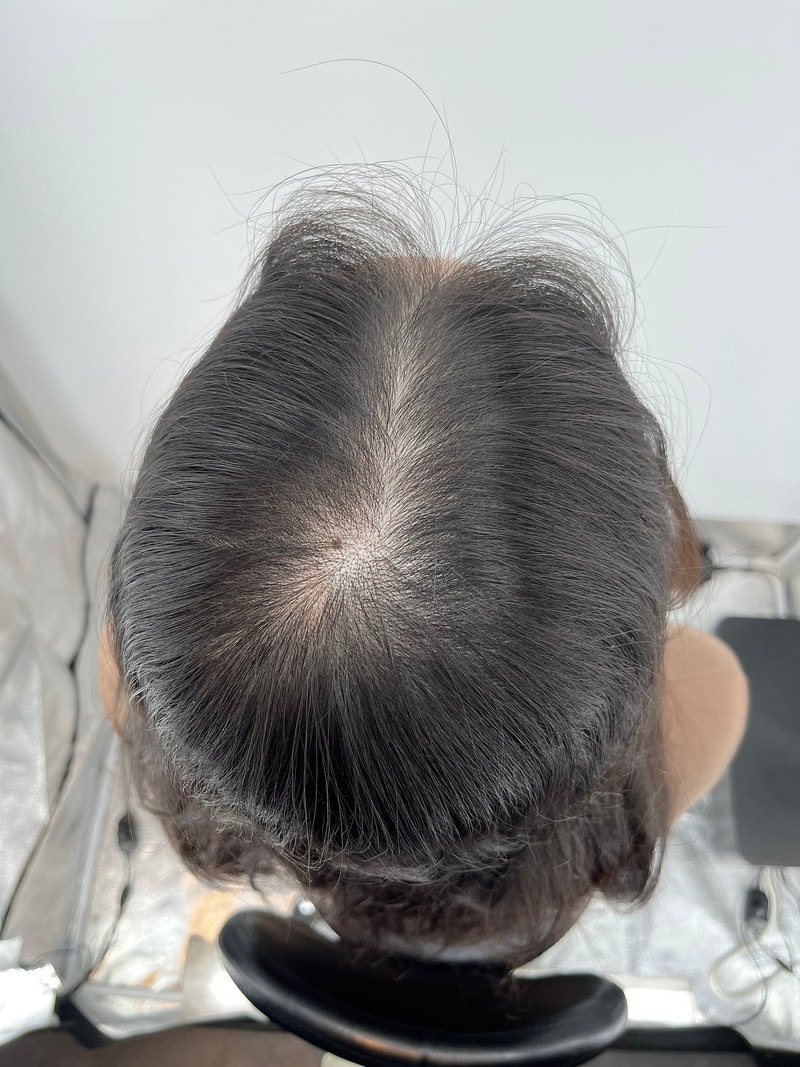 ニューヘアsmp頭皮タトゥー2次完了!
