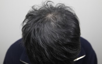 두피문신 4회차