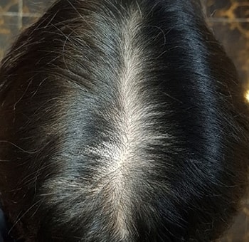 汉奈布整形外科的头皮纹身后记!