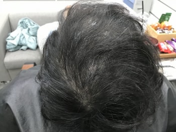 2차 리터치 시술 전
