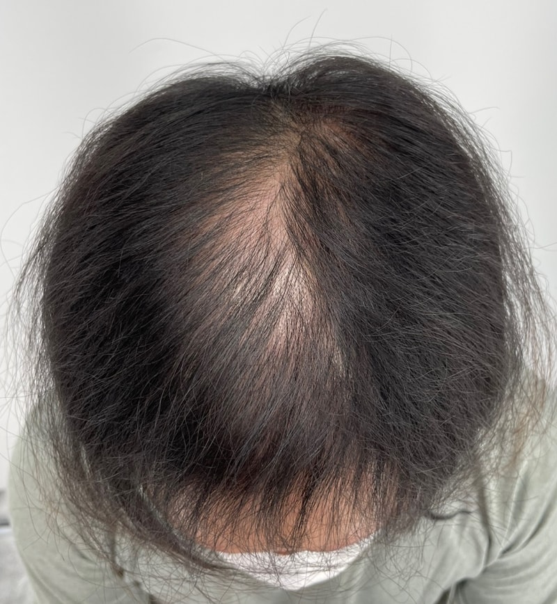 ニューヘアー江南店 smp施術体験談
