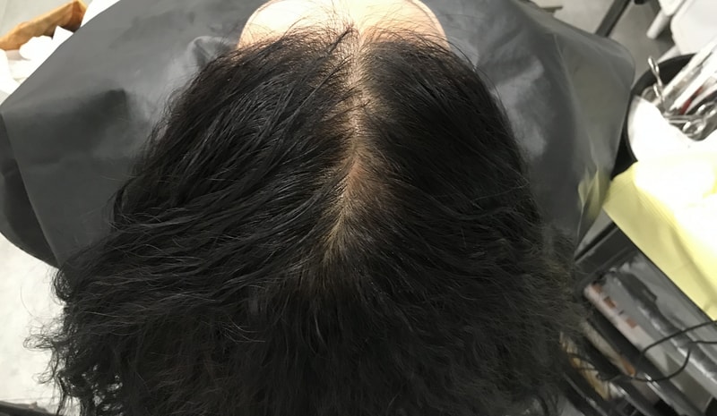 1次ヘアタトゥー5日目の体験談