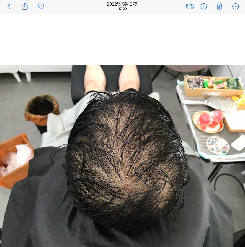 시술 전 젖은 상태 위