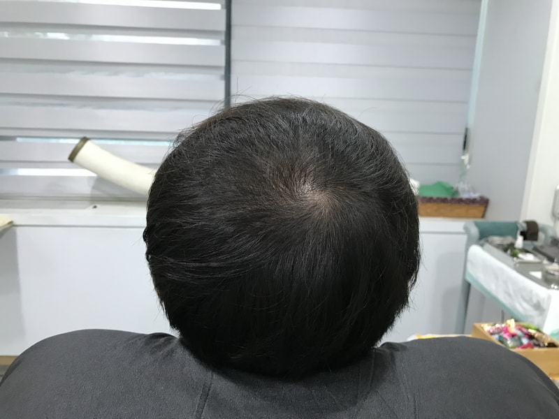 这是头皮纹身第一次后记!