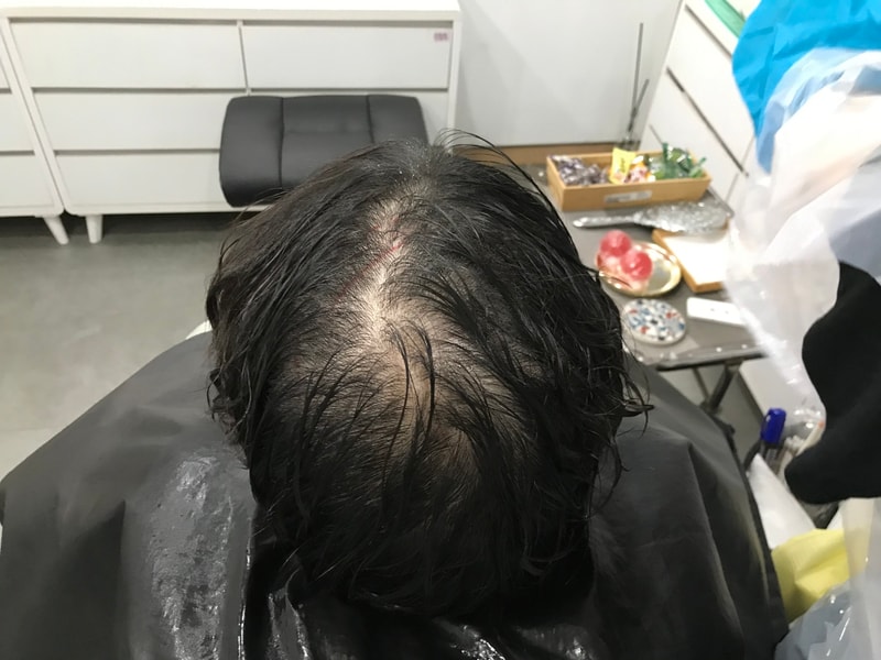 延世美达人头皮纹身1次后记
