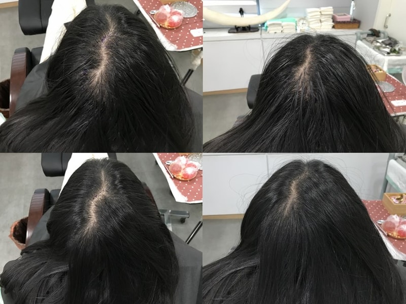激光纹身后记(1次)