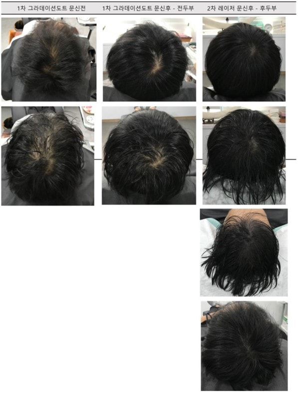 头皮纹身1次(渐变圆点)、2次(激光)后期。