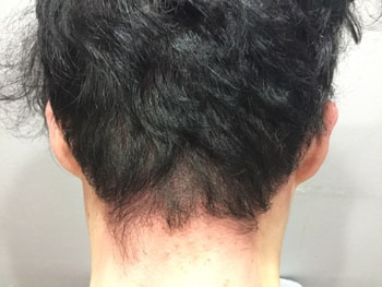 목덜미 문신 후