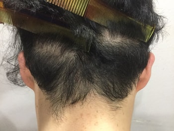 목덜미 문신 전