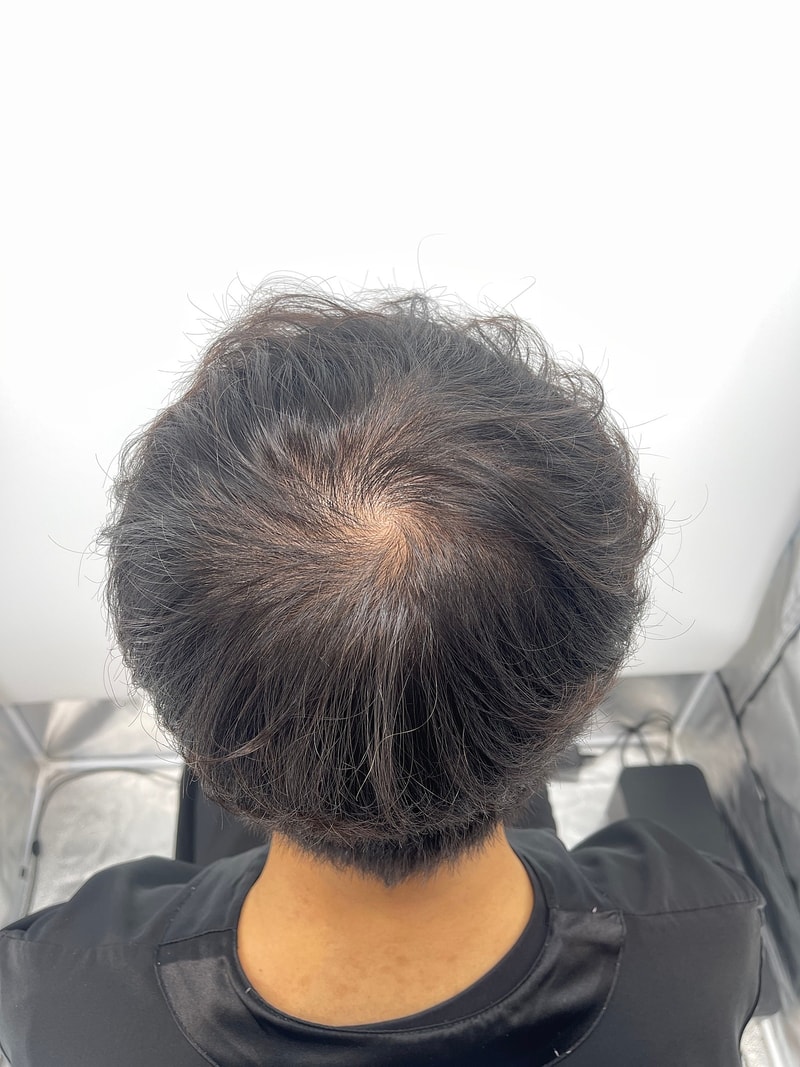 新发型毛发整形外科头皮纹身(SMP)2次手术后记
