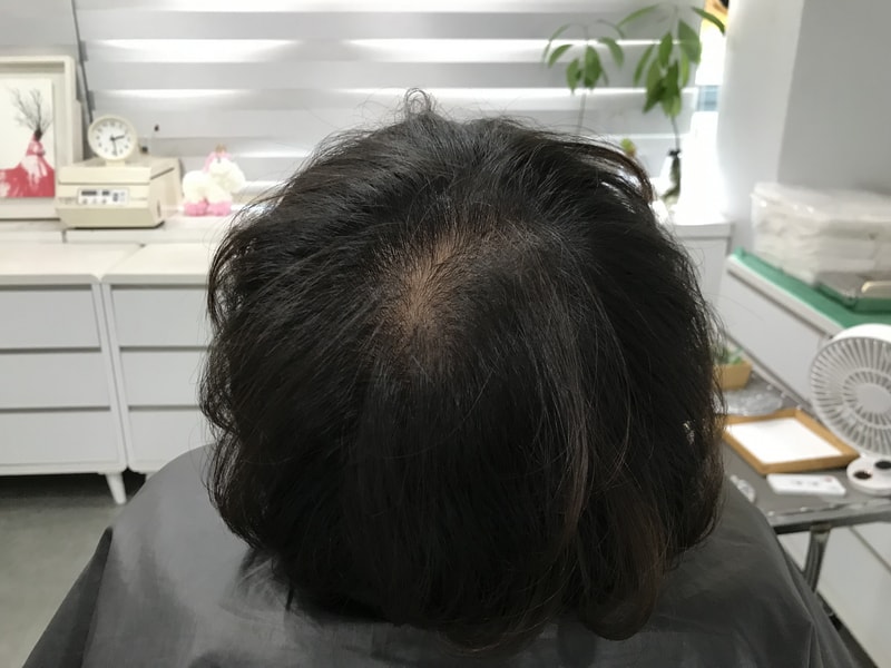 延世美达人头皮纹身后记