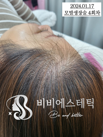 주1회케어 30대중반여성(헤어라인 M자탈모)-1/17