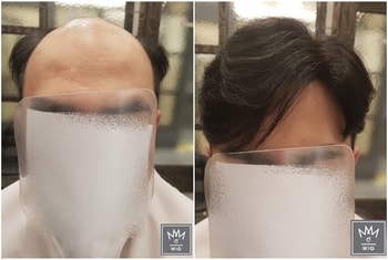 예)남성형 탈모로 인하여 맞춤가발 하신 고객님.