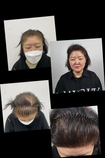 여성 팜므 시술 전후 사진