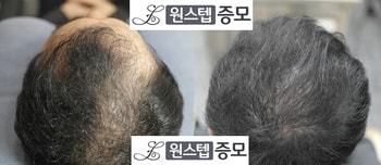 남자 정수리와 m자커버