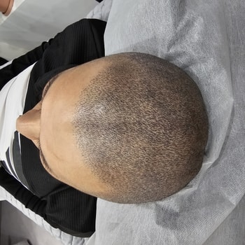 3D아트기법의 SMP두피문신