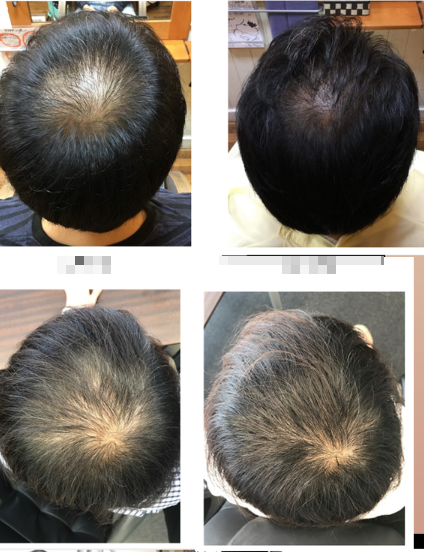 남성탈모(www.ziyega.com)