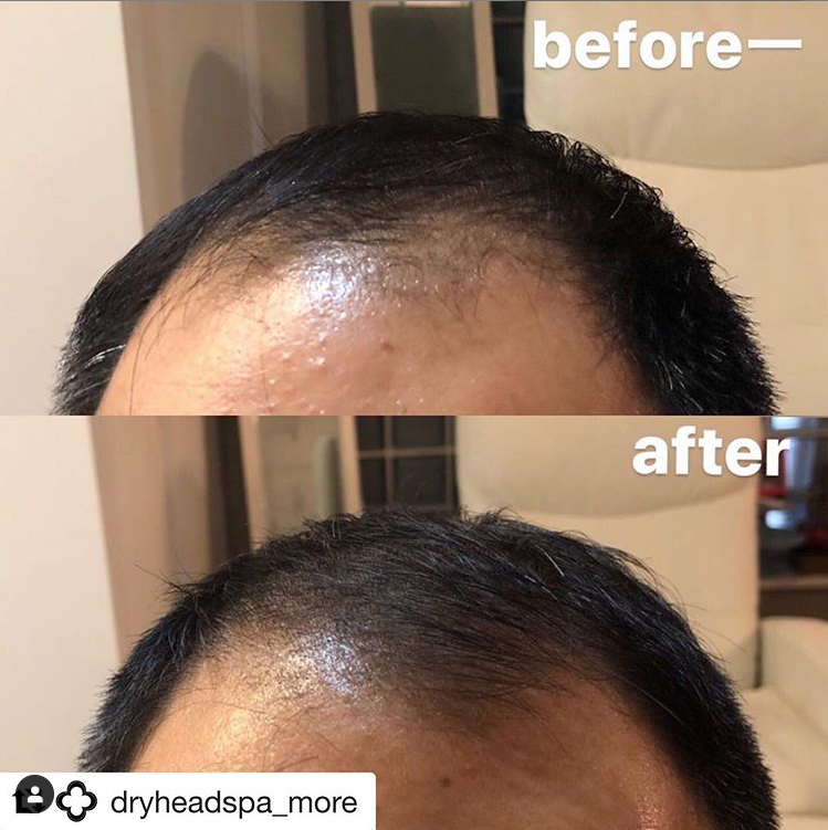 앞머리탈모 개선(50대 남성)