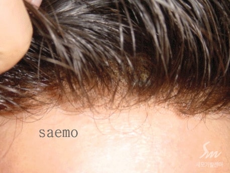 이마라인의 자연스러움