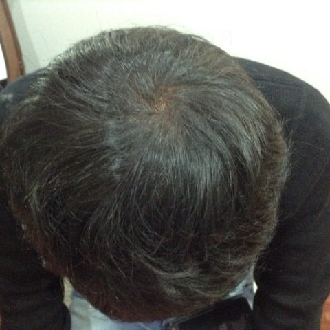 시술후2